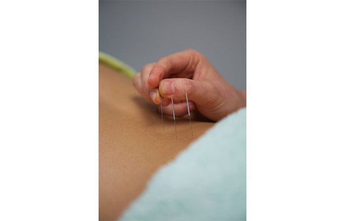 acunpunture