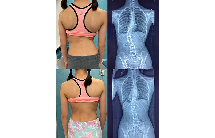 脊柱側彎施羅德運動治療 Scoliosis Schroth Exercise Training