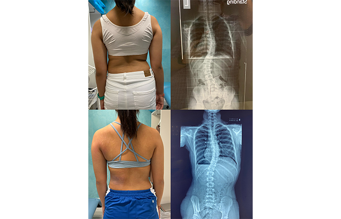 脊柱側彎施羅德運動治療 Scoliosis Schroth Exercise Training