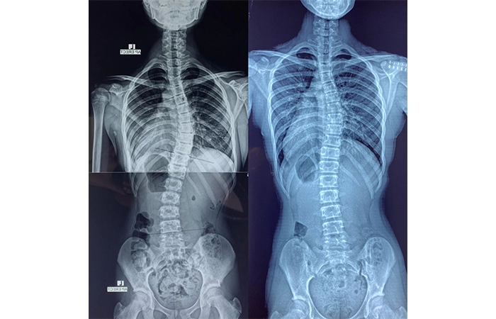 脊柱側彎施羅德運動治療 Scoliosis Schroth Exercise Training